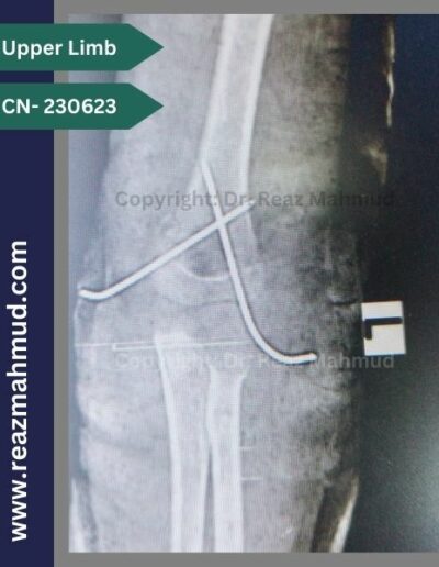 220906- Supracondylar postoperative