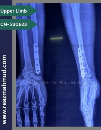 220907- Distal Ulna Fracture follow up