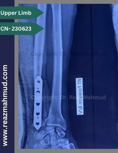 220907- Distal Ulna Fracture postoperative