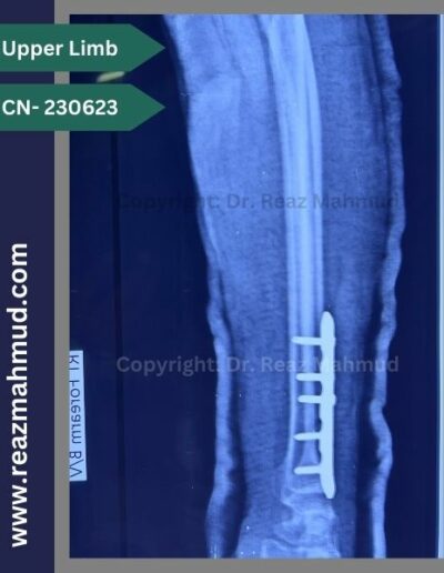 220907- Distal Ulna Fracture postoperative