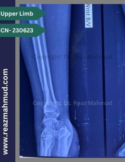 220907- Distal Ulna Fracture preoperative