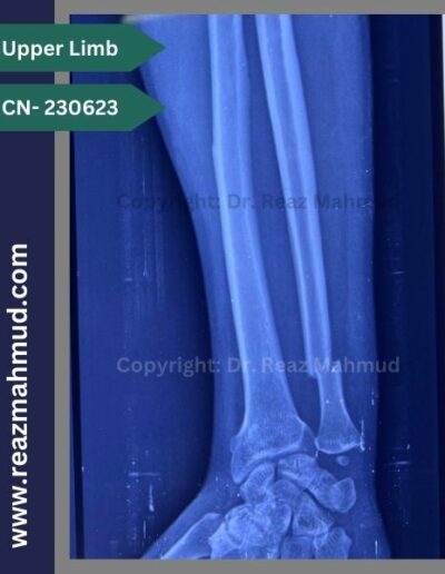 220907- Distal Ulna Fracture preoperative