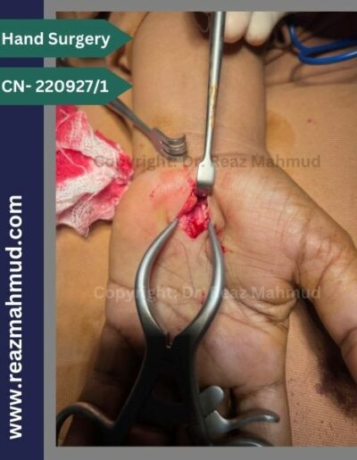 220927_1- CTS+Trigger finger peroperative