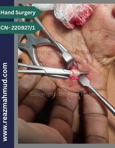 220927_1- CTS+Trigger finger peroperative