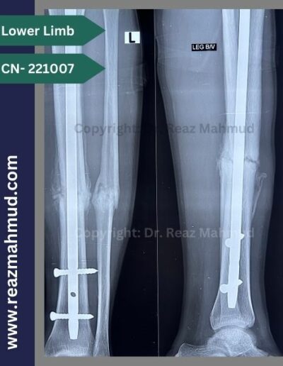 tibia fibula open fracture icd 10