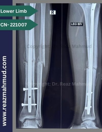 221007- open fracture tibia-fibula postoperative