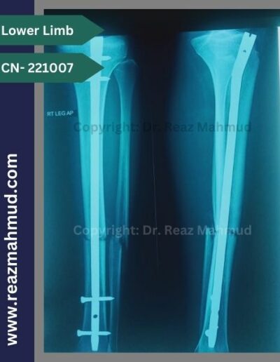 221007- open fracture tibia-fibula postoperative