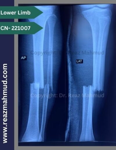 221007- open fracture tibia-fibula preoperative