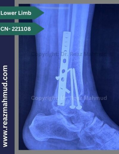 221108- Trimalleolar fracture follow up