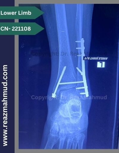 221108- Trimalleolar fracture follow up