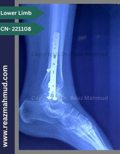 221108- Trimalleolar fracture follow up