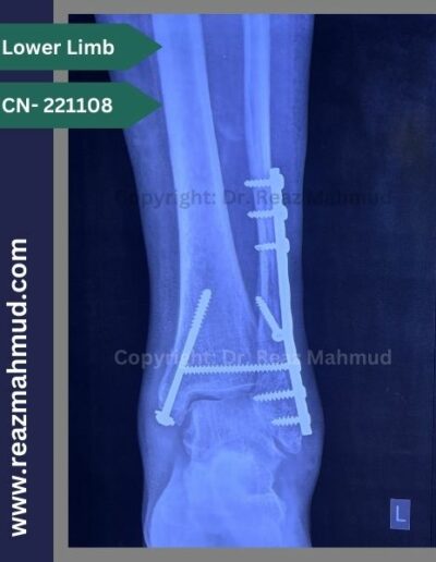 221108- Trimalleolar fracture follow up