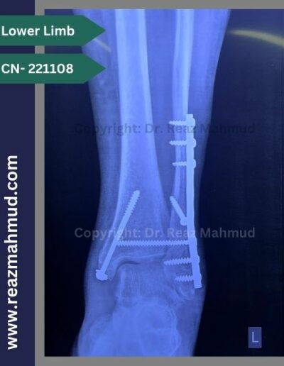 221108- Trimalleolar fracture follow up