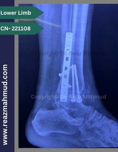 221108- Trimalleolar fracture follow up