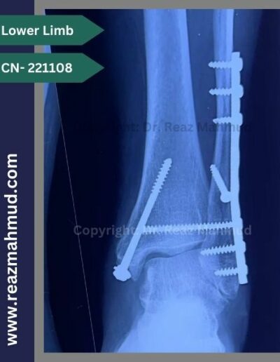 221108- Trimalleolar fracture follow up