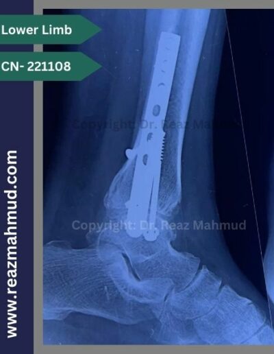 221108- Trimalleolar fracture follow up