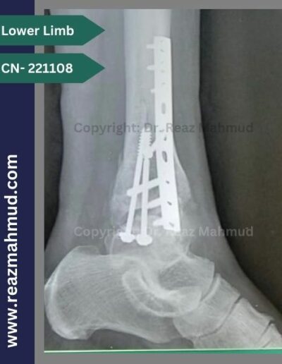 221108- Trimalleolar fracture postoperative