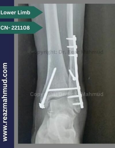 221108- Trimalleolar fracture postoperative