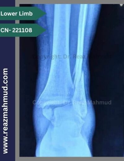 221108- Trimalleolar fracture prep