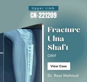 Ulna shaft fracture | ORIF [CN-221209]