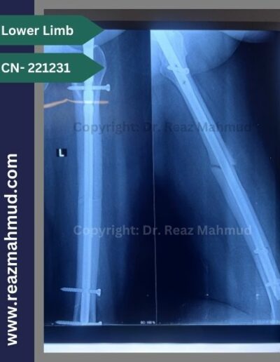 221231- Femur fracture Follow up