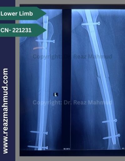 221231- Femur fracture Follow up