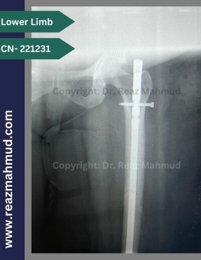 221231- Femur fracture postop