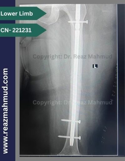 221231- Femur fracture postop