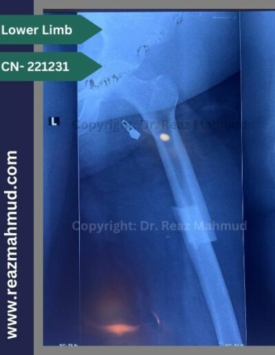 221231- Femur fracture preop