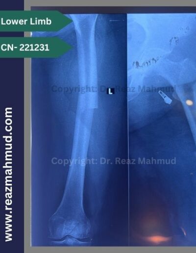 221231- Femur fracture preop