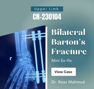 Bilateral Barton’s fracture | Mini Ex-fix [CN-230104]