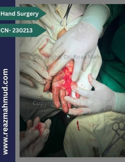 Dupuytrens Contracture peroperative