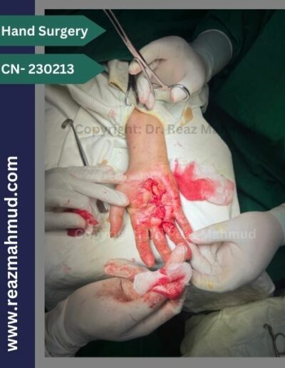 Dupuytrens Contracture peroperative