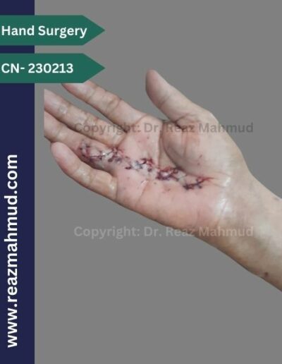 Dupuytrens Contracture postoperative