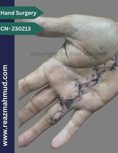 Dupuytrens Contracture postoperative