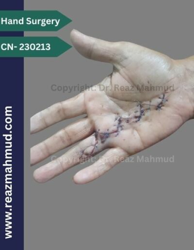 Dupuytrens Contracture postoperative