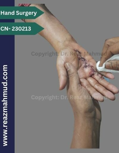 Dupuytrens Contracture postoperative