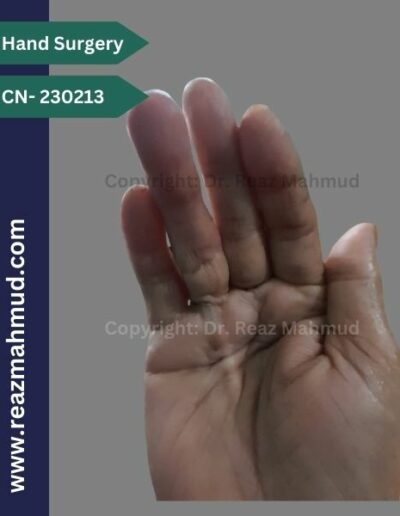 Dupuytrens Contracture