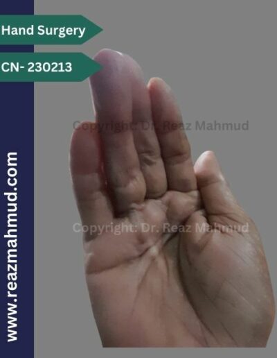 Dupuytrens Contracture