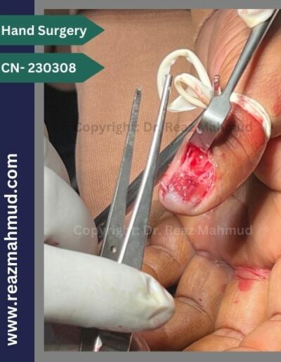 Excision of Nailbed Neurofibroma