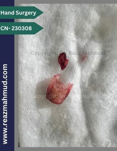 Avulsed nail and tumour tissue