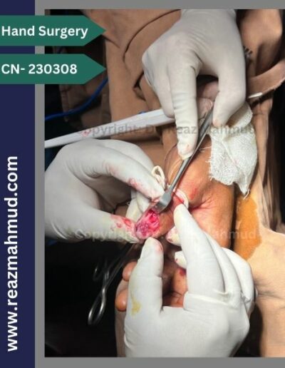 Excision of Nailbed Neurofibroma