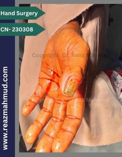 Nailbed Neurofibroma