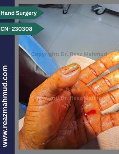 Nailbed Neurofibroma