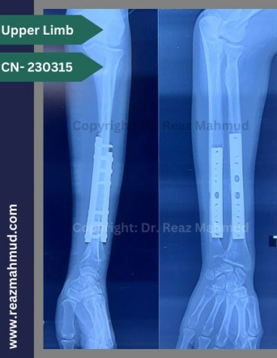 Fracture Shaft of Radius Ulna Follow Up