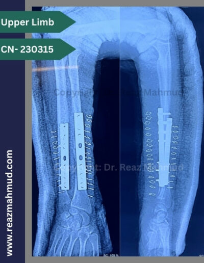 Fracture Shaft of Radius Ulna Postoperative