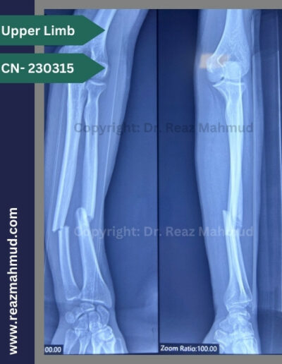 Fracture Shaft of Radius Ulna Preoperative