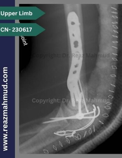 230617 communited condylar humerus postoperative