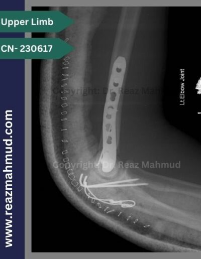 230617 communited condylar humerus postoperative