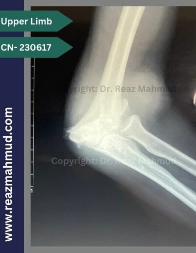 230617 communited condylar humerus preoperative